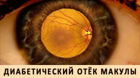 Фармакоэкономический анализ применения антиангиогенной лекарственной терапии при лечении диабетического макулярного отёка
